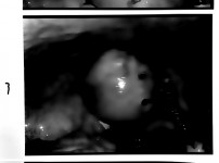 Myomectomy 자궁근종 (복강경이용)절제술