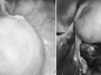 낭종 절제술 (Cystectomy)